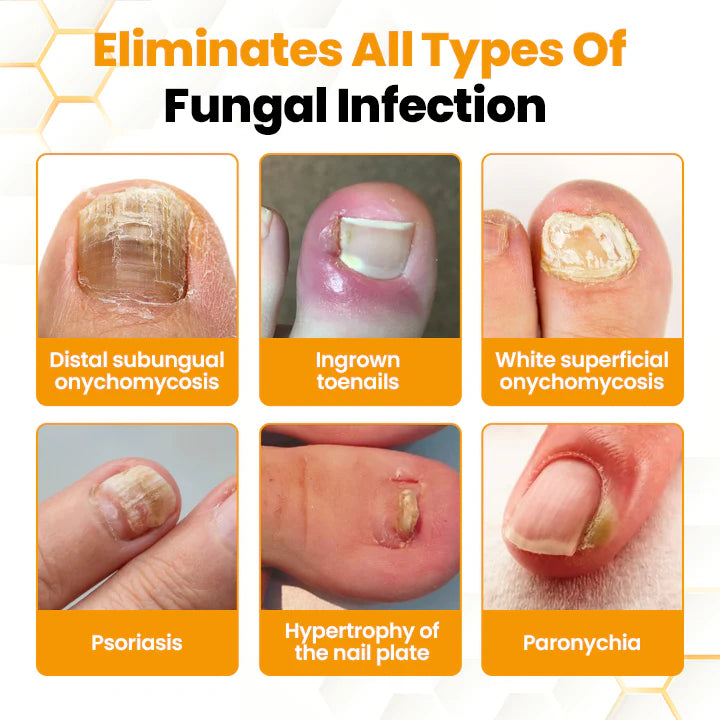 Antifungal Nail Revitalizing Oil with Bee Venom